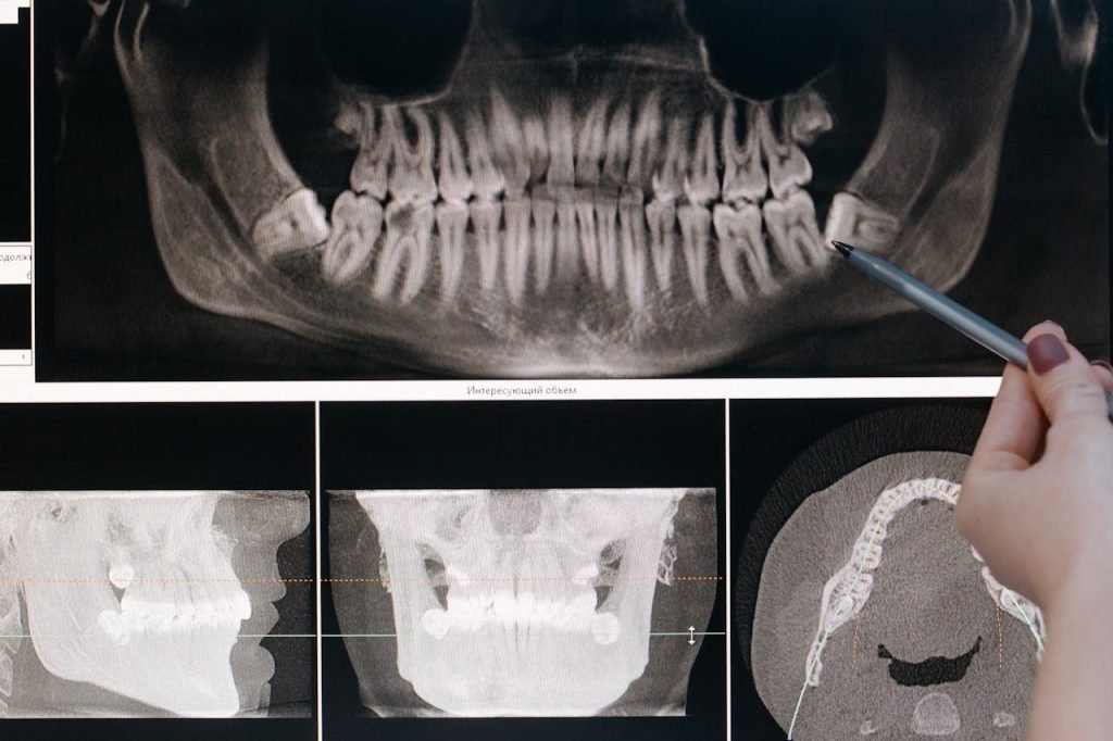 Detailed dental X-ray showing teeth structure highlighted by a pointing pen.